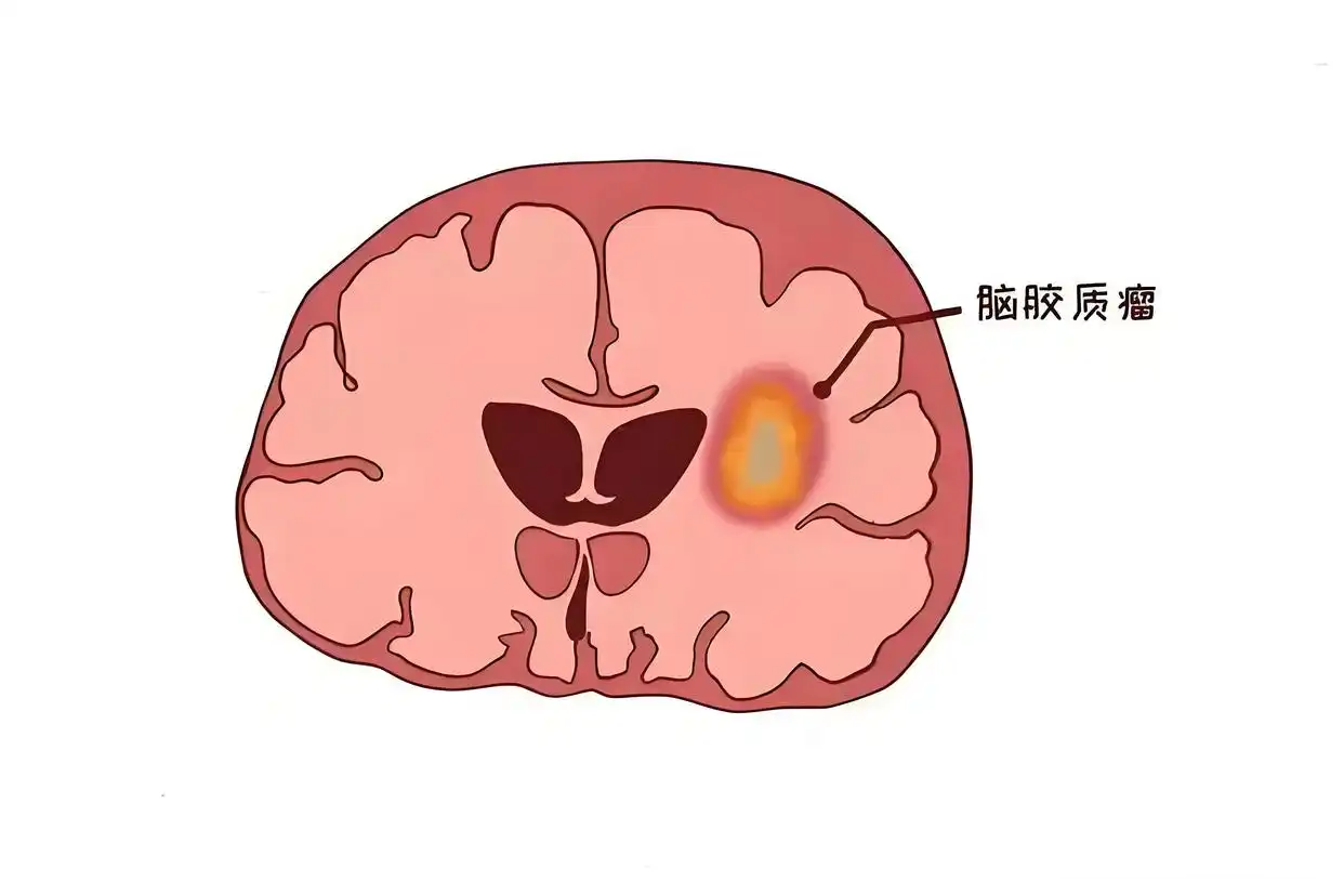 胶质瘤.png